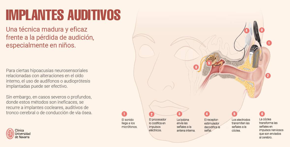 Infografía sobre distintos tipos de implantes auditivos Infografía publicada en la revista de la CUN y replicada en la web.