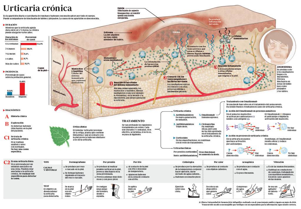 Infografía con toda la información sobre la urticaria crónica