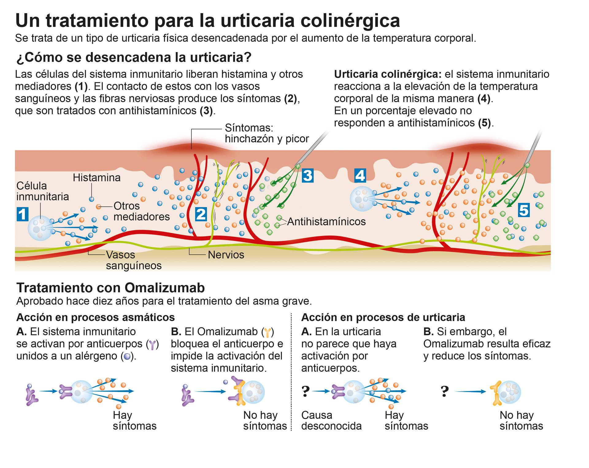 Infografía sobre un tratamiento para la urticaria colinérgica