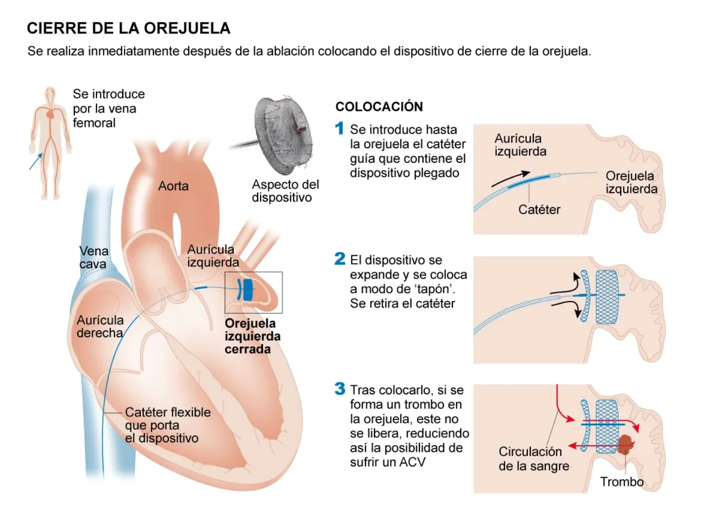 Infografía con el proceso del cierre de la orejuela para la prevención del ictus en la fibrilación auricular. Clínica Universidad de Navarra.