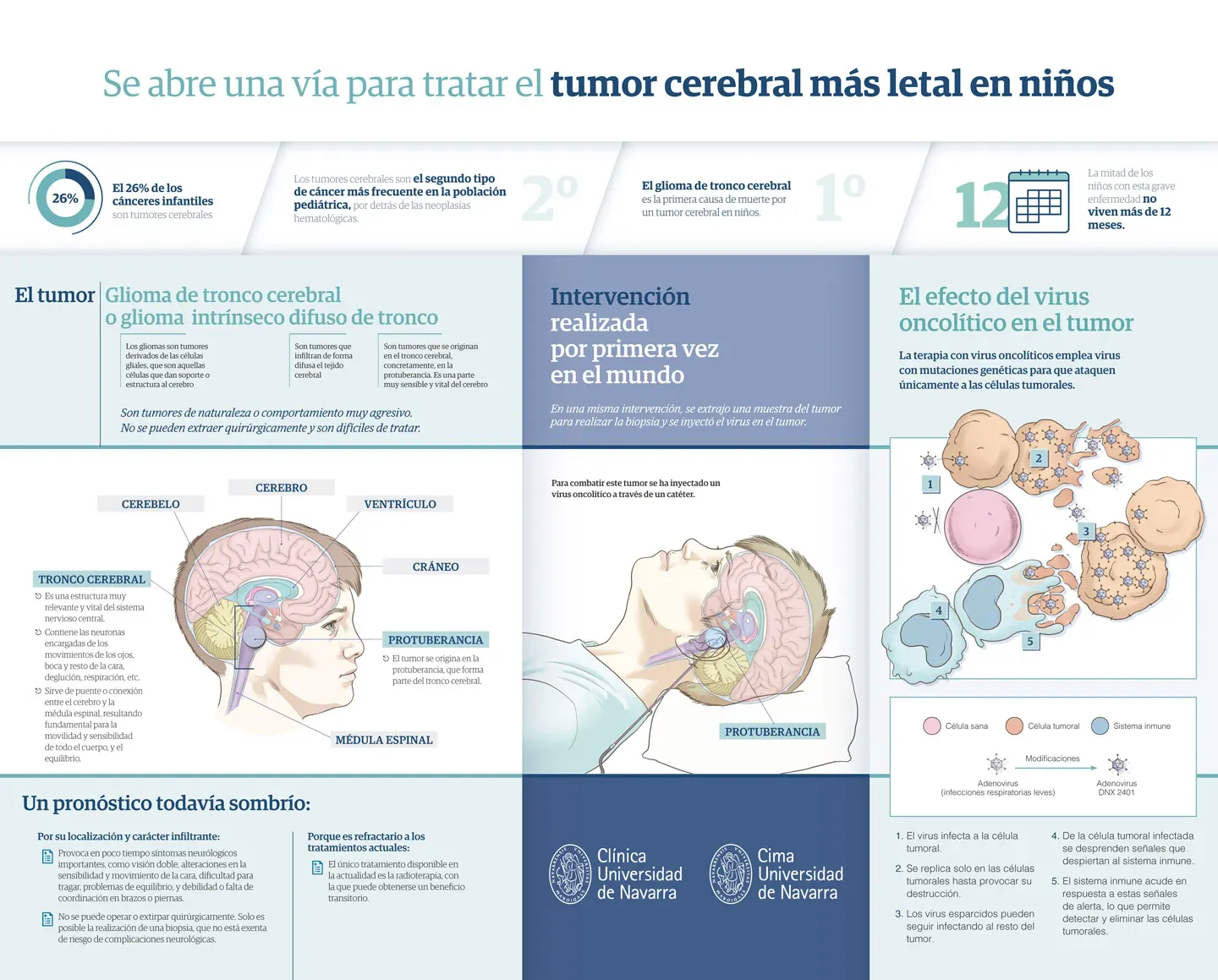 Infografía sobre el tratamiento del glioma cerebral en niños con virus delta oncolíticos. Investigación de la CUN y Cima Universidad de Navarra