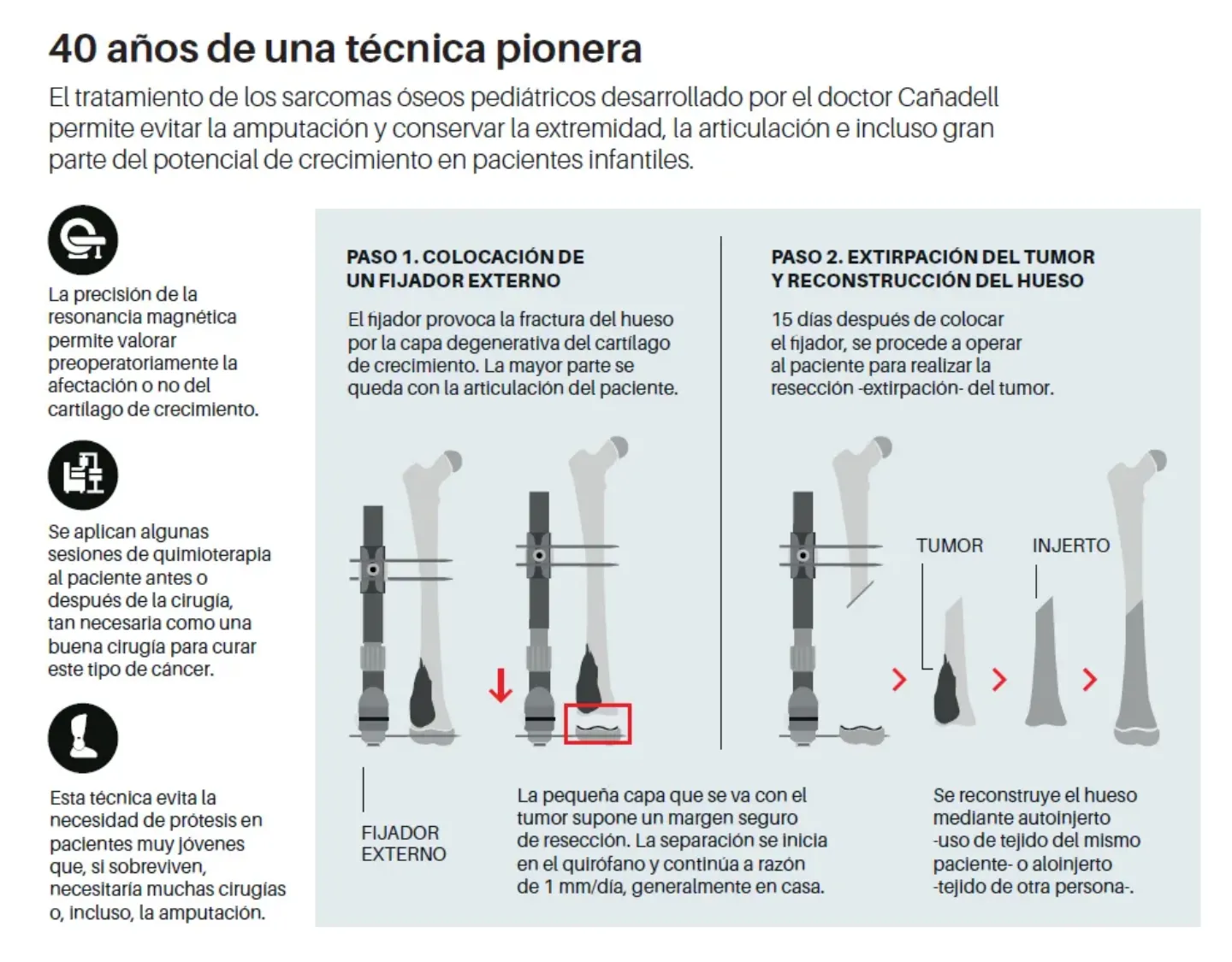 Infografía explicativa de la técnica Cañadell para evitar la amputación de la extremidad en tumores óseos. Clínica Universidad de Navarra