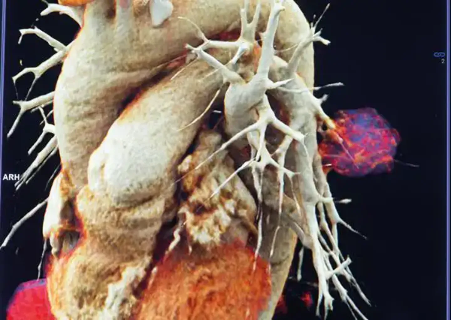 Reconstrucción en 3D de un tumor de pulmón Imagen de una reconstrucción en 3D de un tumor de pulmón para la mejora del diagnóstico en la Clínica Universidad de Navarra.