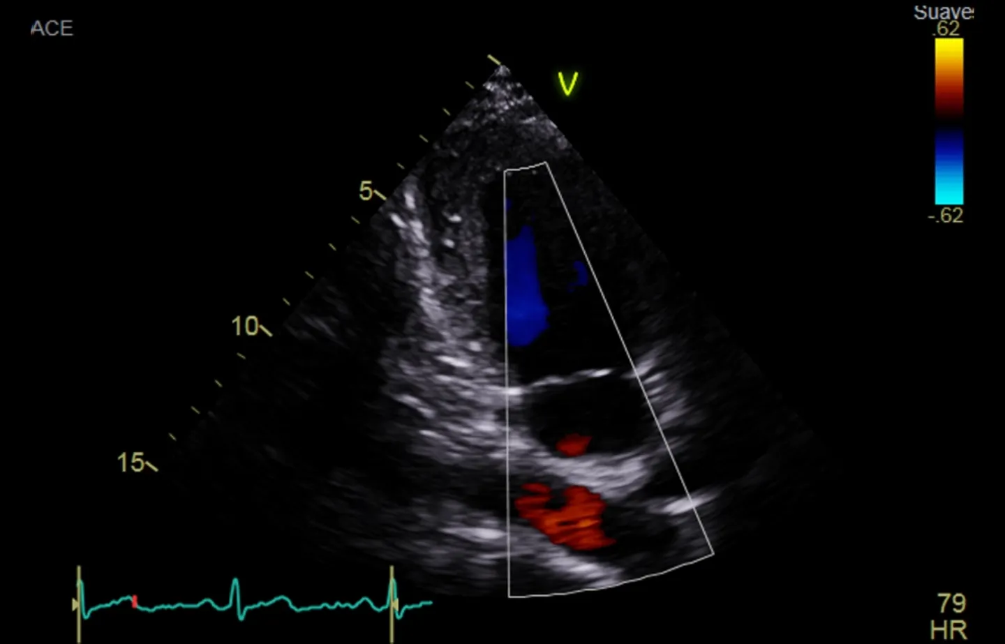 Imagen de ecocardiograma doppler del corazón de una mujer.
