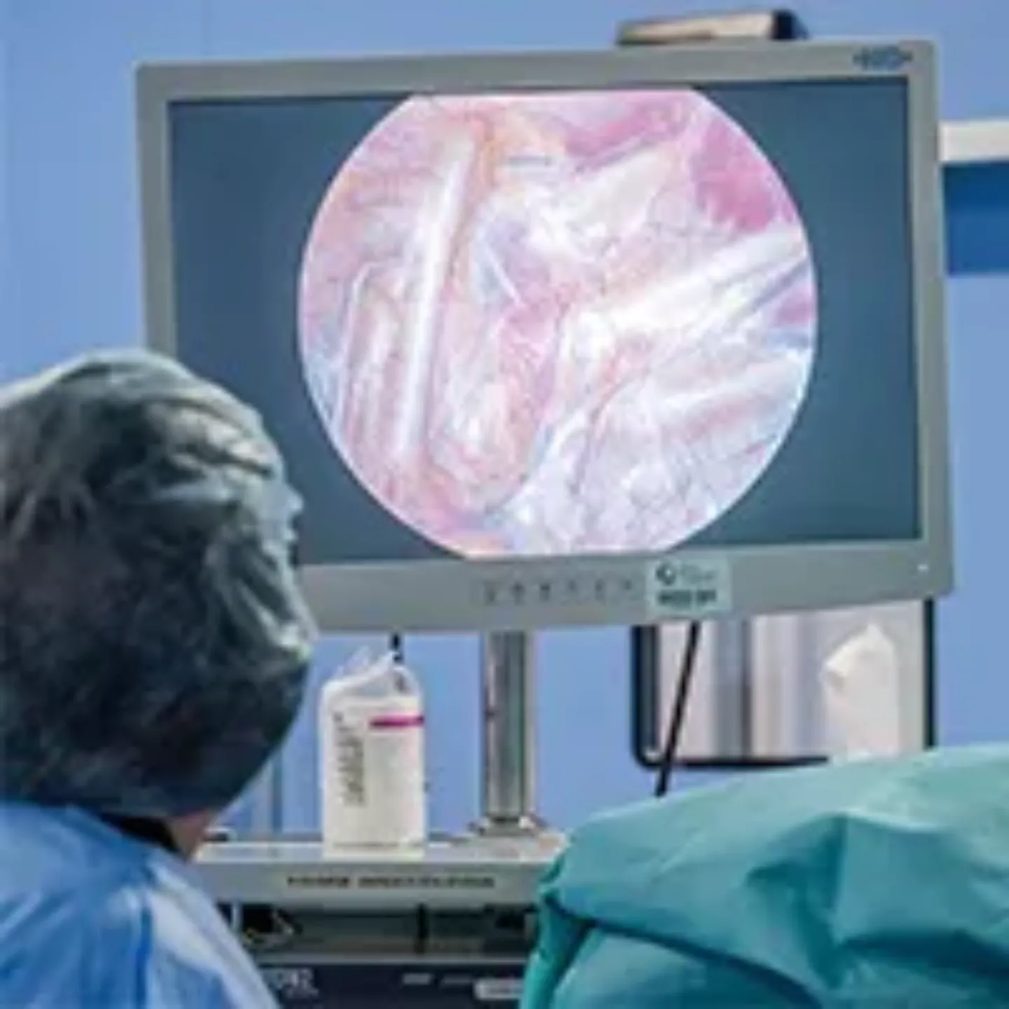 Imagen del quirófano de cirugía torácica, realizando una a cirugía para la hiperhidrosis. Clínica Universidad de Navarra