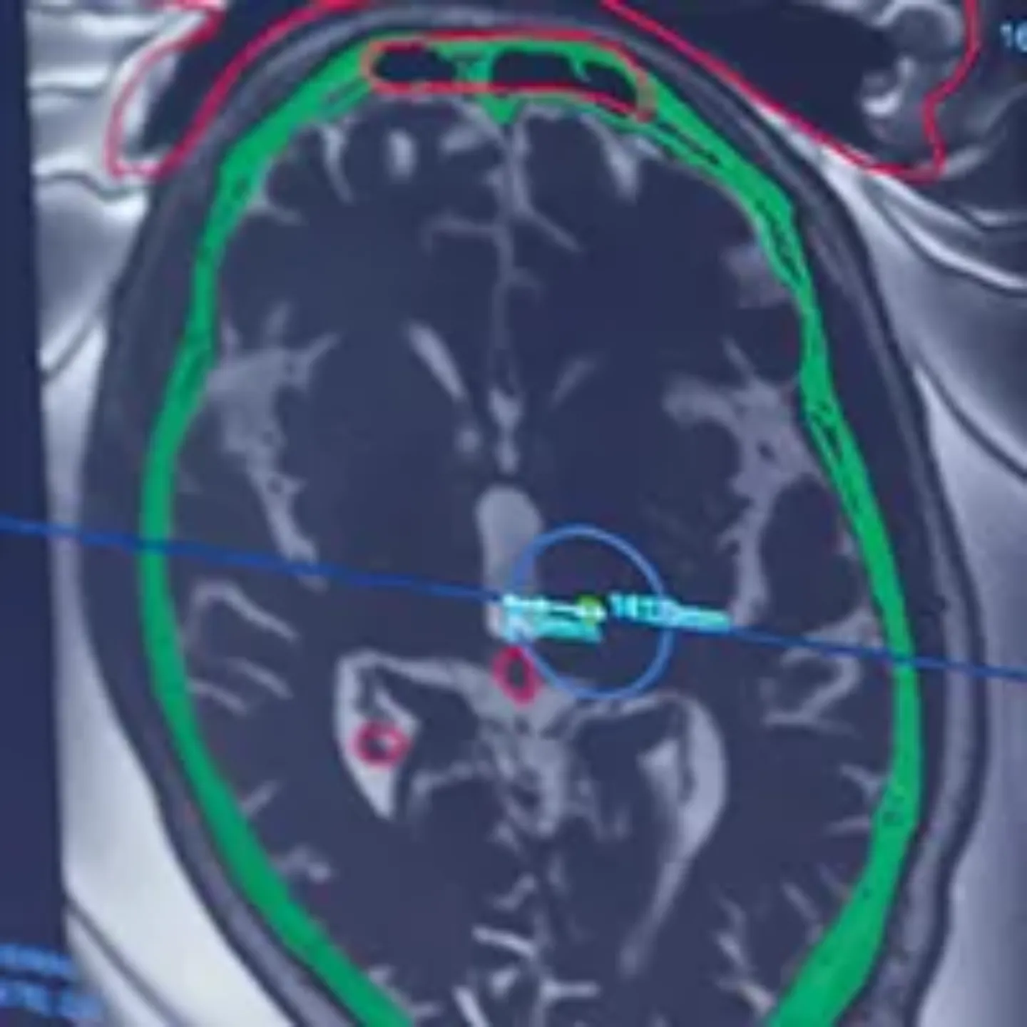Imagen de una resonancia magnética para el tratamiento con HIFU para el temblor. Clínica Universidad de Navarra