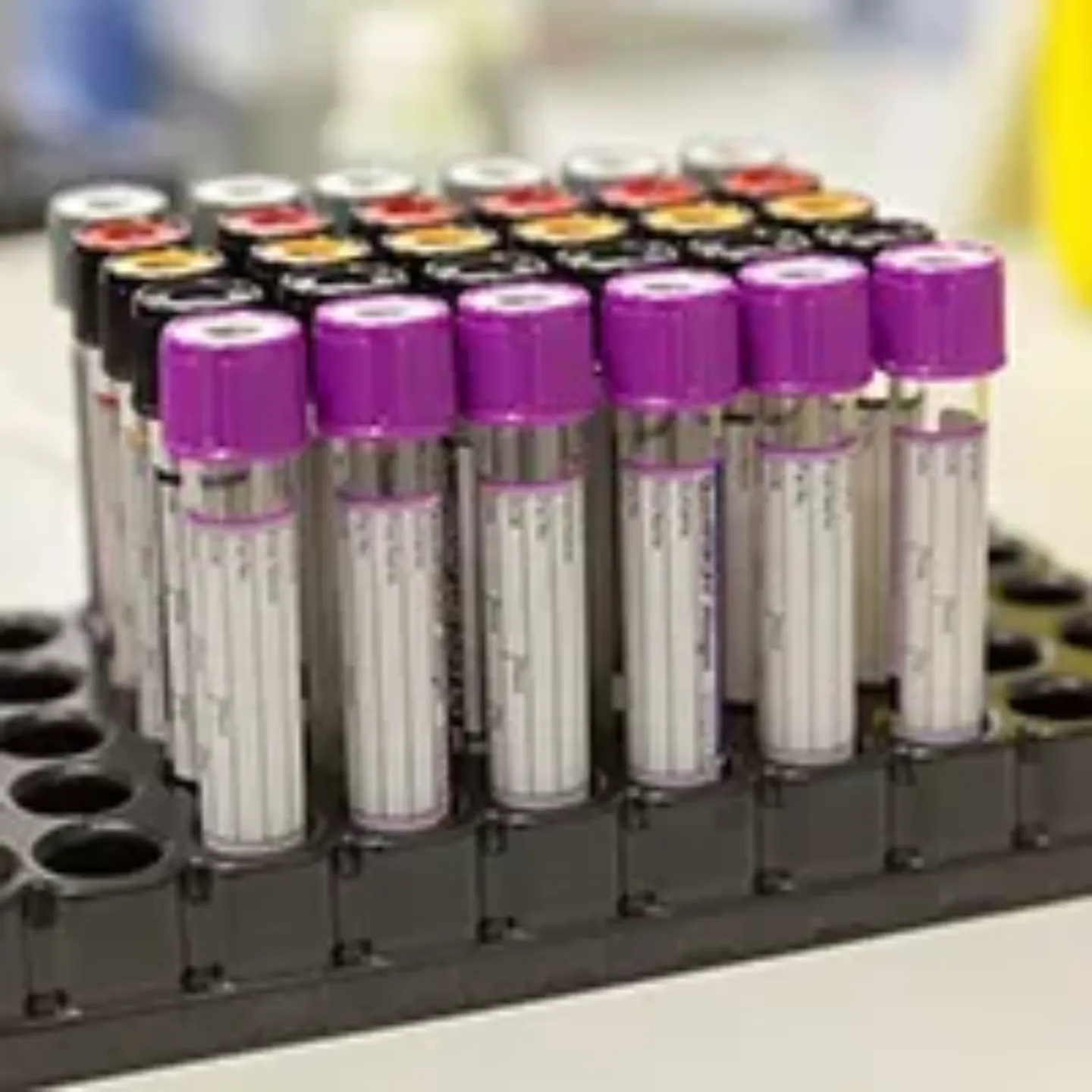 Imagen de pruebas de inmunidad para detectar el Covid-19. Clínica Universidad de Navarra