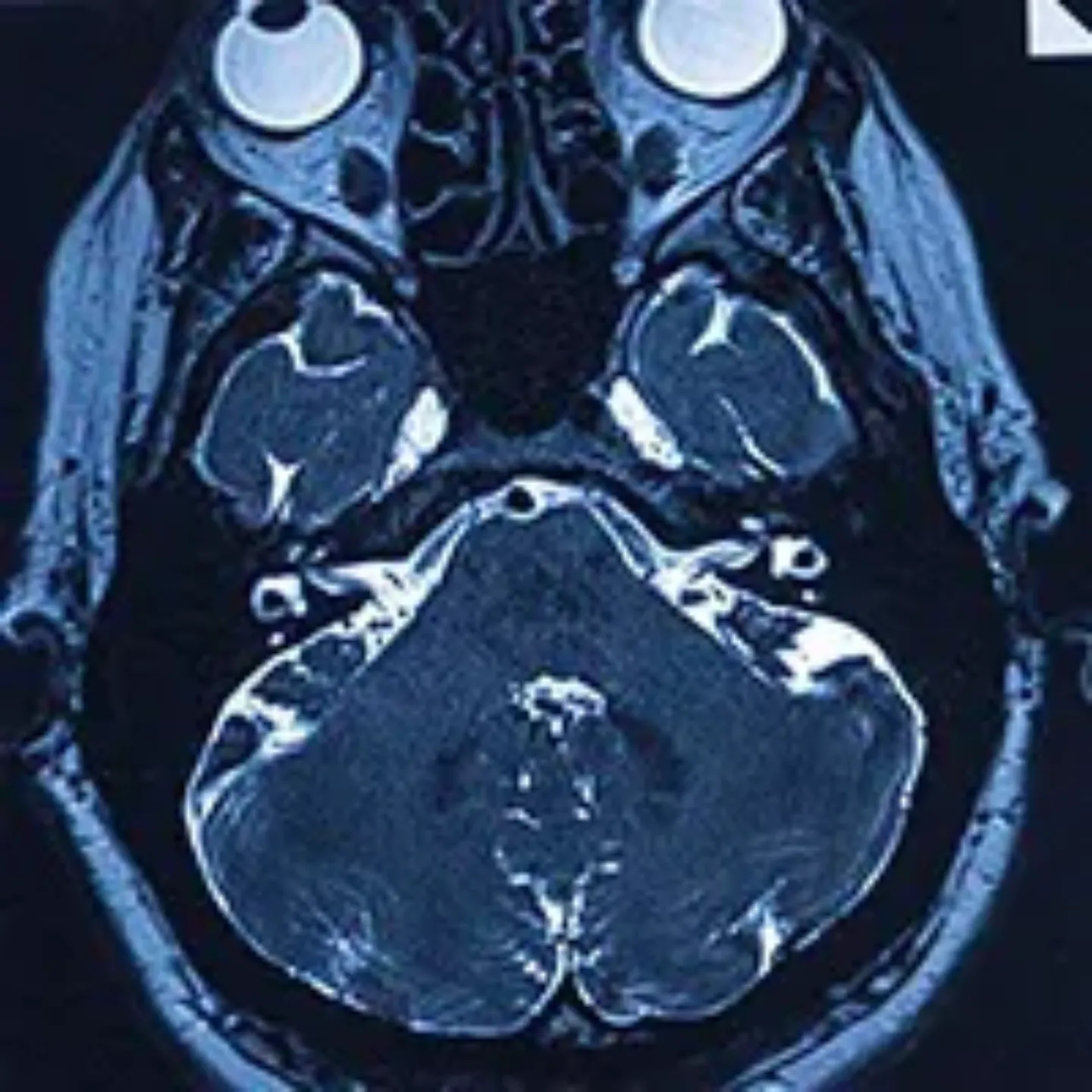 Imagen RMN cerebral en enfermedad de Menière. Clínica Universidad de Navarra