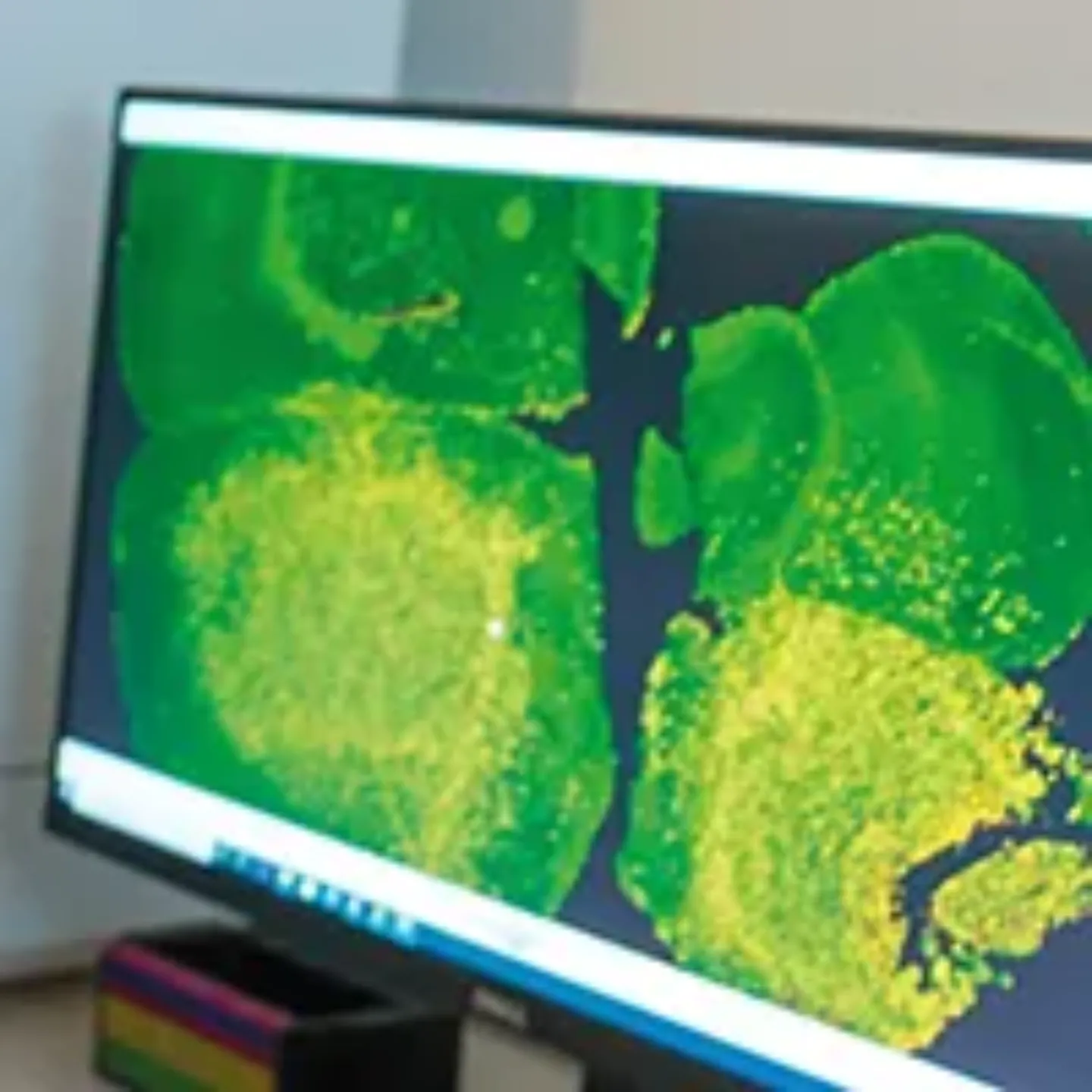 Imagen al microscopio de células tumorales. Clínica Universidad de Navarra