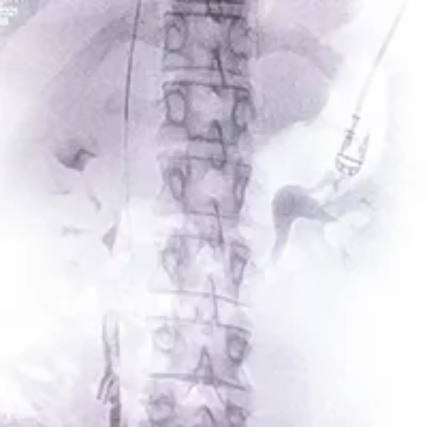 Imagen del tratamiento mínimamente invasivo para tratar las varices pélvicas. Clínica Universidad de Navarra