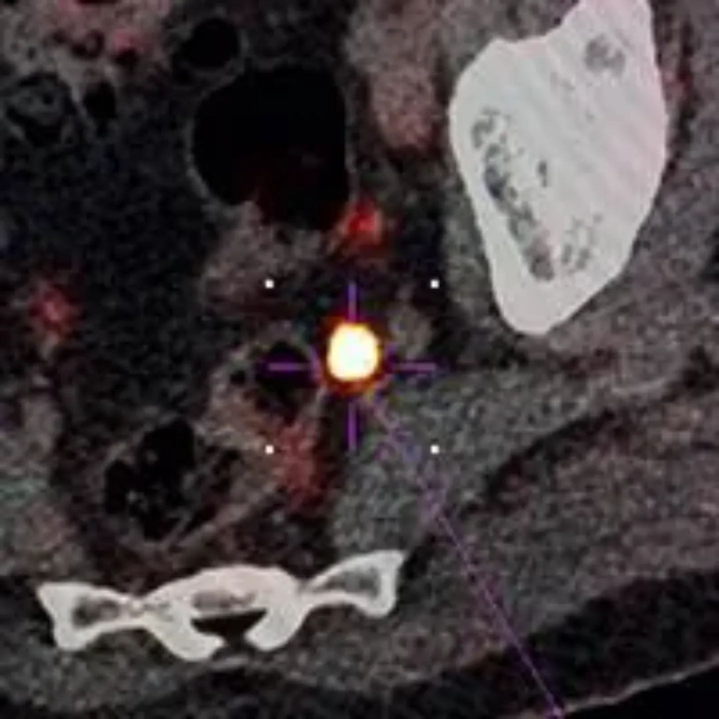 Imagen del tratamiento para el cáncer de próstata. Clínica Universidad de Navarra