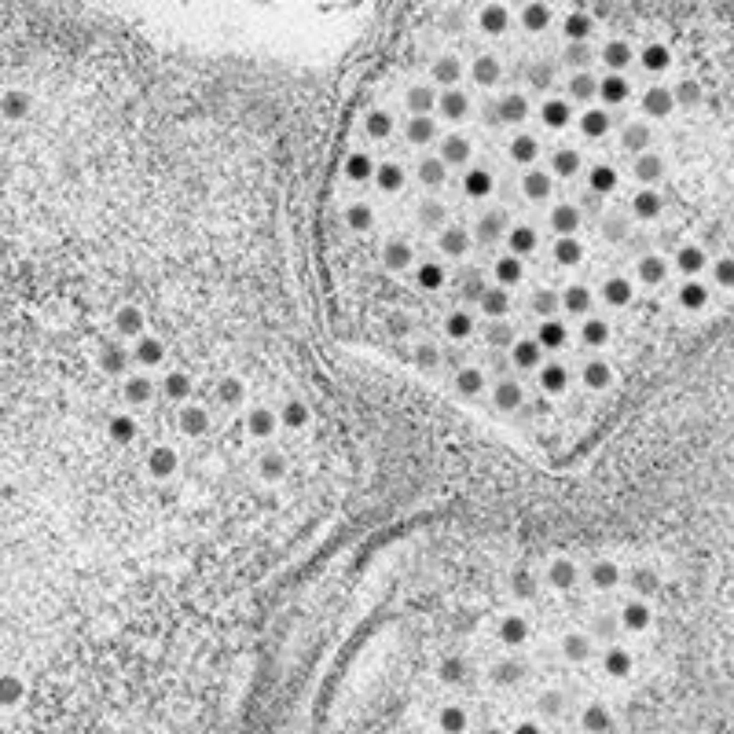 Imagen al microscopio de un tumor cerebral. Clínica Universidad de Navarra