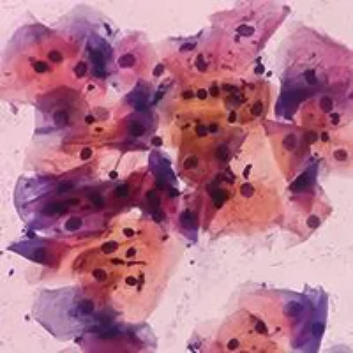 Imagen al microscopio de células de un cáncer de cérvix uterino. Clínica Universidad de Navarra