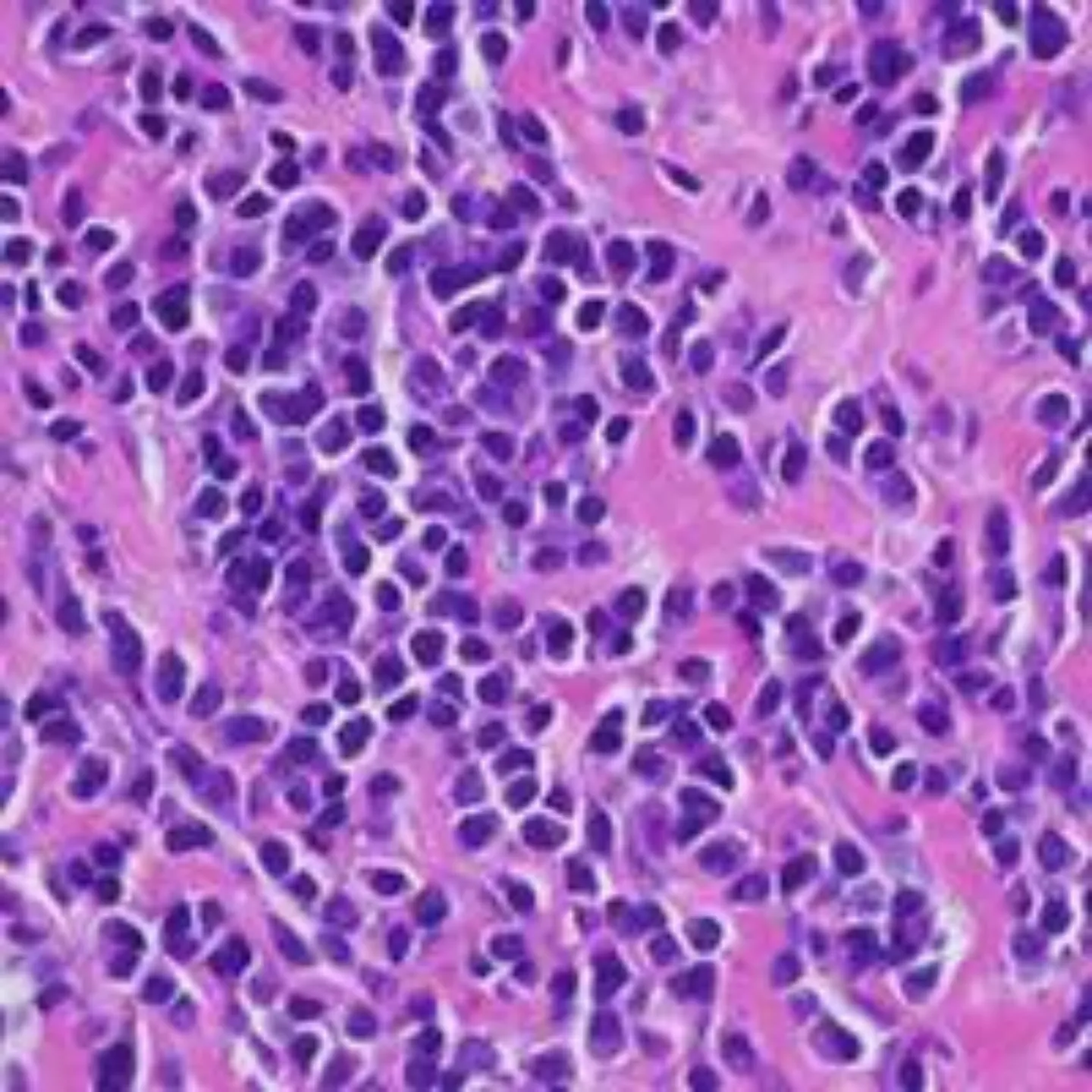 Imagen al microscopio de células tumorales del mieloma múltiple. Clínica Universidad de Navarra