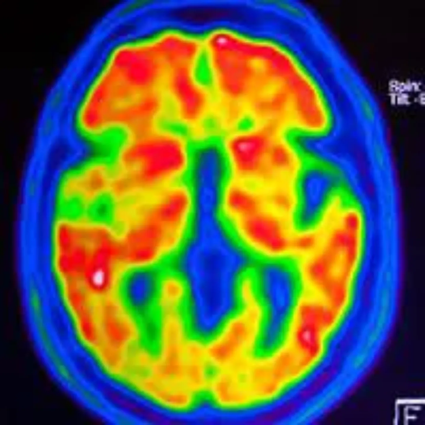 Imagen de un PET de un cerebro con Alzheimer, estudio mentol. Clínica Universidad de Navarra