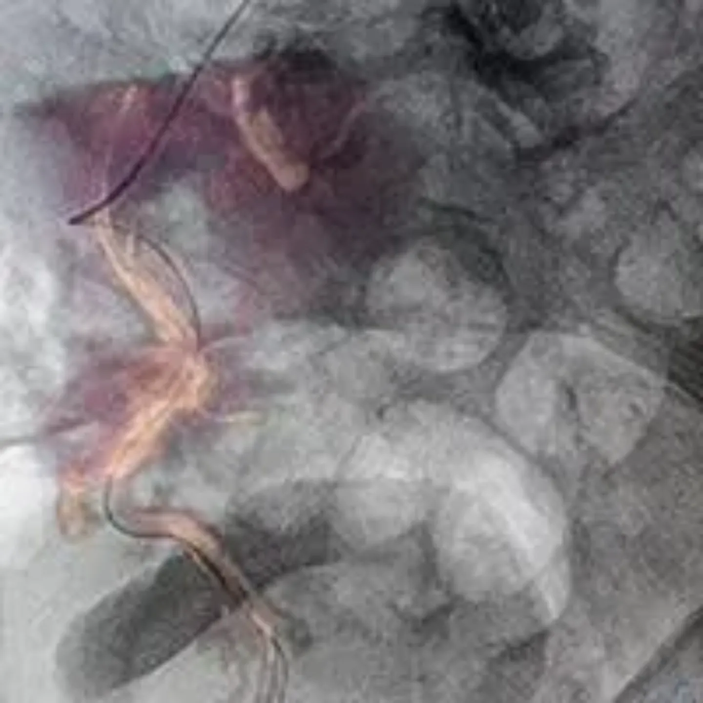 Imagen de una embolización prostática para tratar la hiperplasia benigna de próstata. Clínica Universidad de Navarra