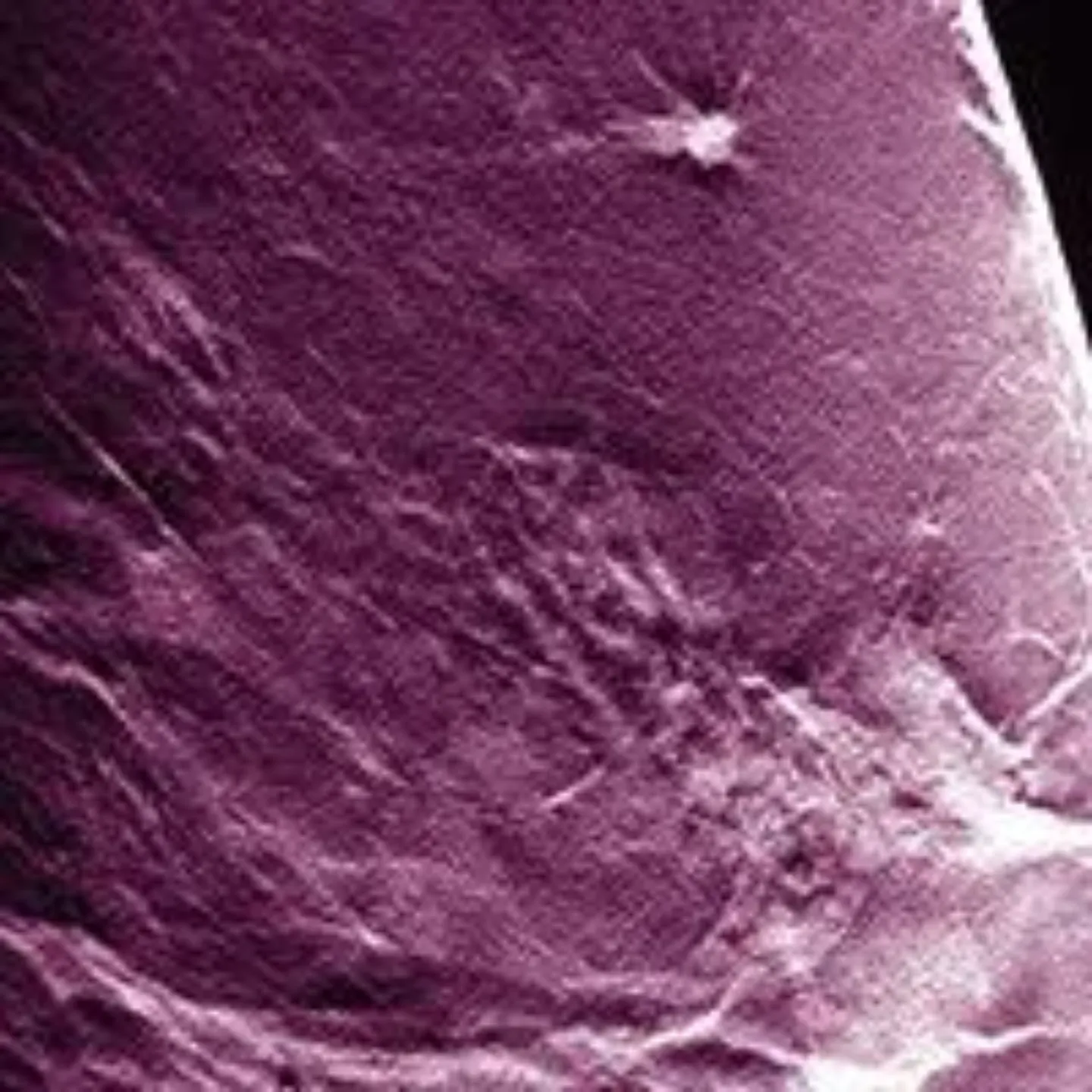 Imagen de un cáncer de mama visto al microscopio. Clínica Universidad de Navarra.