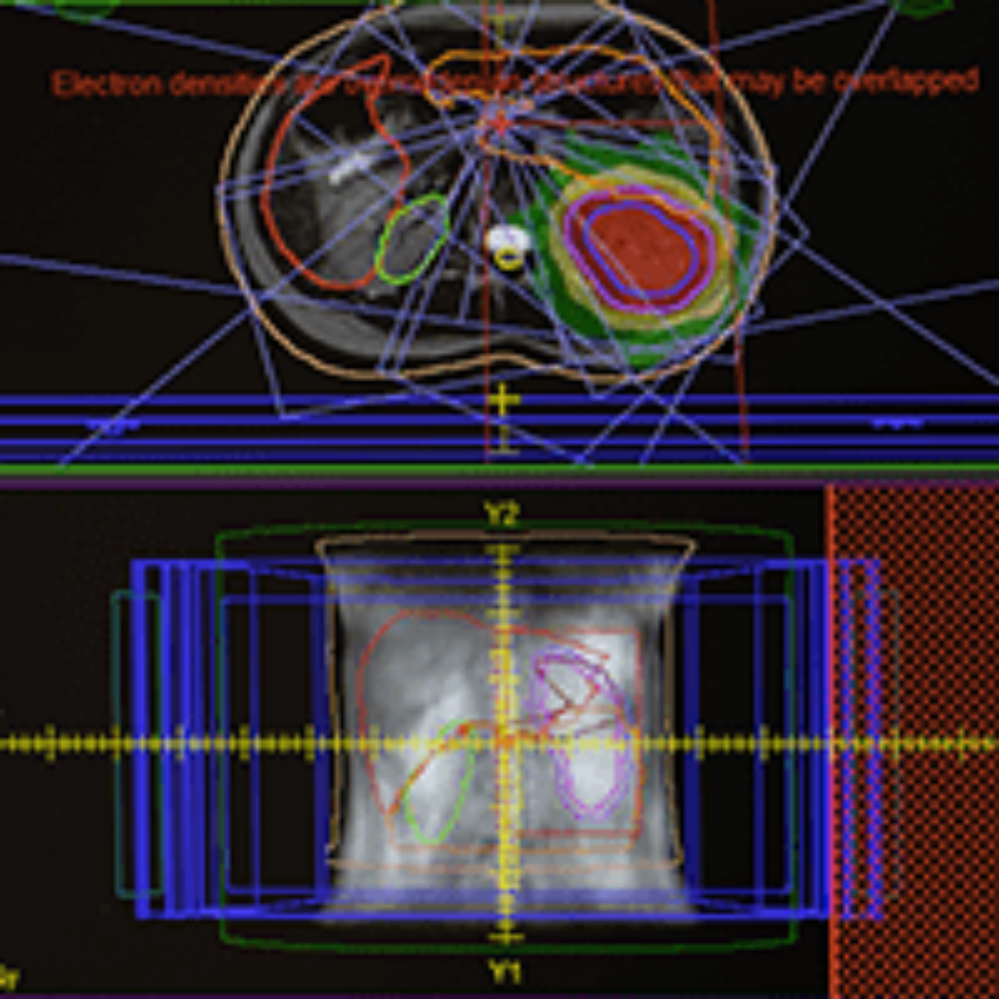 Imagen de una pantalla de ordenador con imágenes volumétricas de un tratamiento de radioterapia con el MR Linac. Clínica Universidad de Navarra