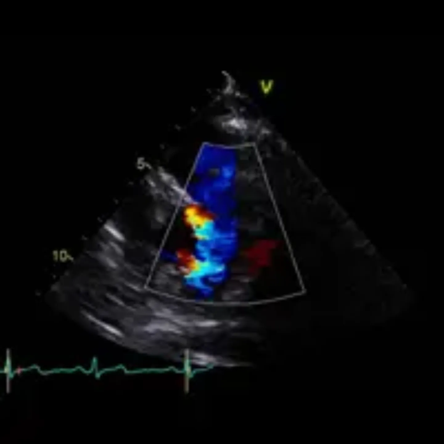 Imagen de un ecocardiograma doppler del corazón de una mujer.
