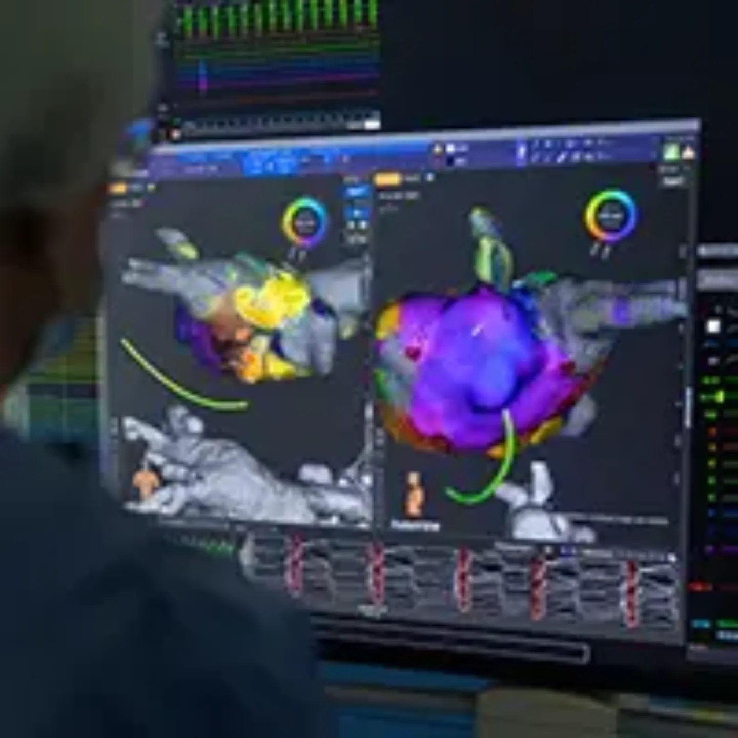 Imagen de un quirófano de electrofisiología donde se ve una pantalla con la imagen mapeada del corazón con colores.