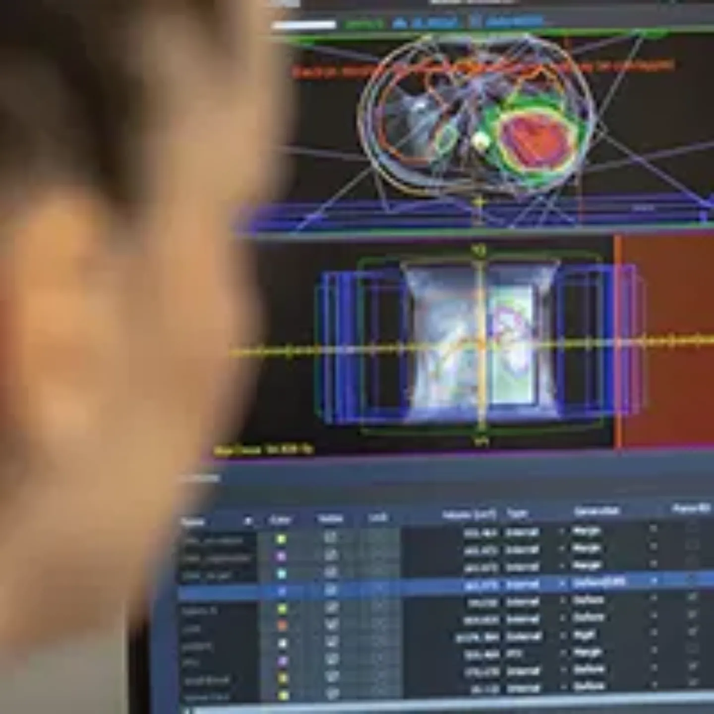 Imagen de una pantalla con la planificación de un tratamiento de radioterapia.