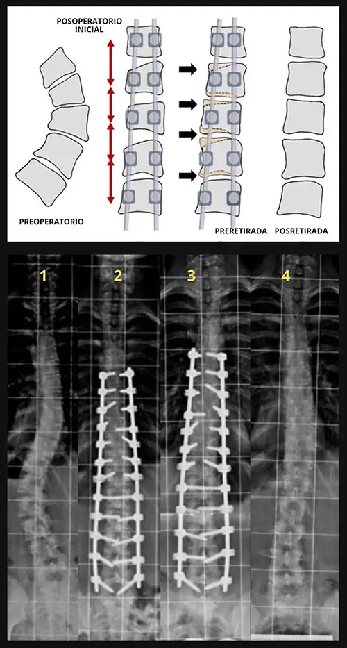 Cirugía sin fusión para la escoliosis