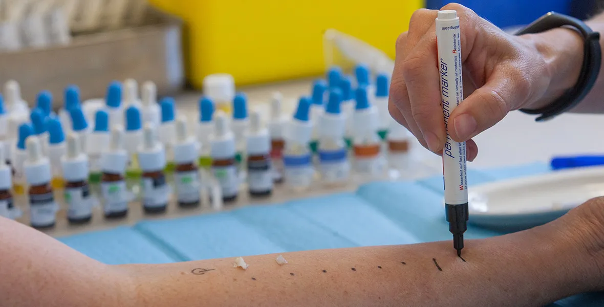 Pruebas de alergia realizadas en el departamento de Alergología