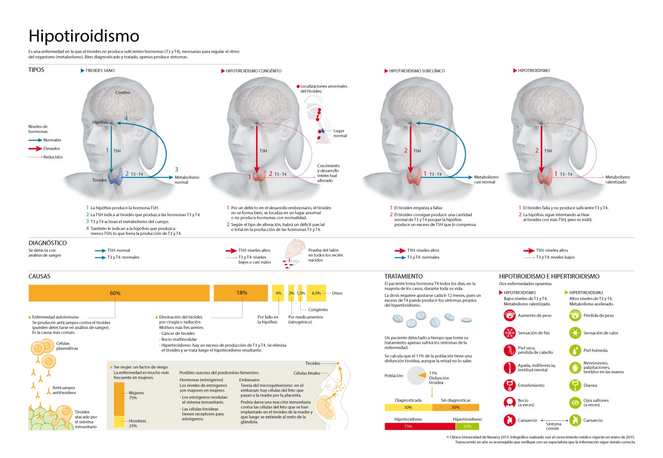 Infografía sobre el hipotiroidismo