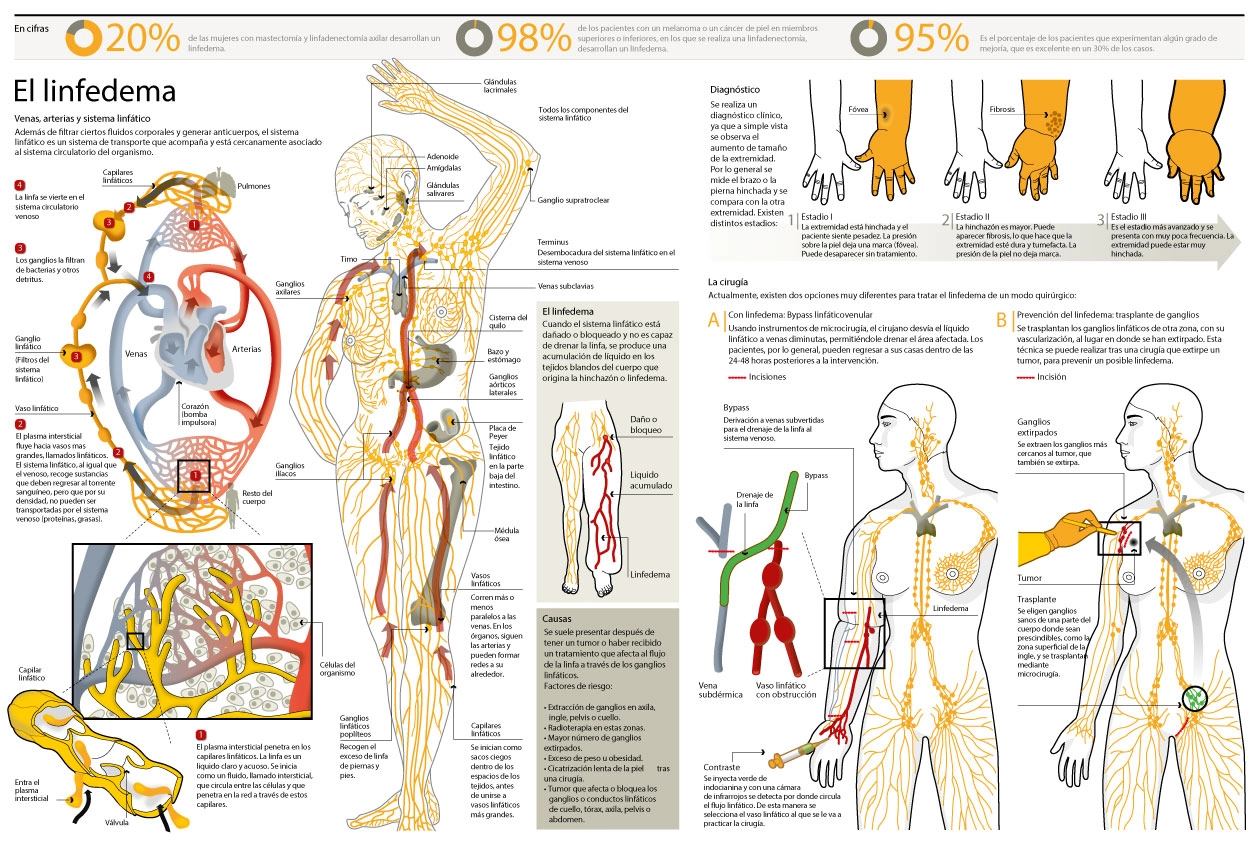 Infografía con todos los detalles sobre qué es el linfedema
