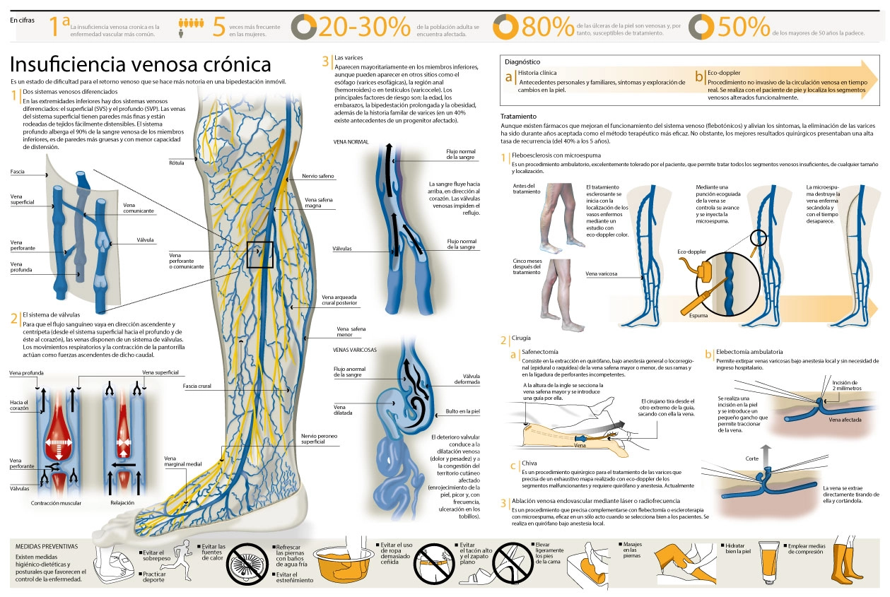 Infografía sobre las varices, qué es la insuficiencia venosa crónica
