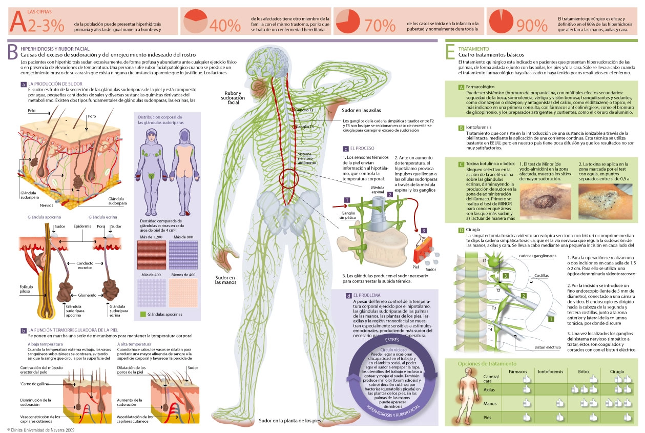 Infografía con información completa sobre la hiperhidrosis