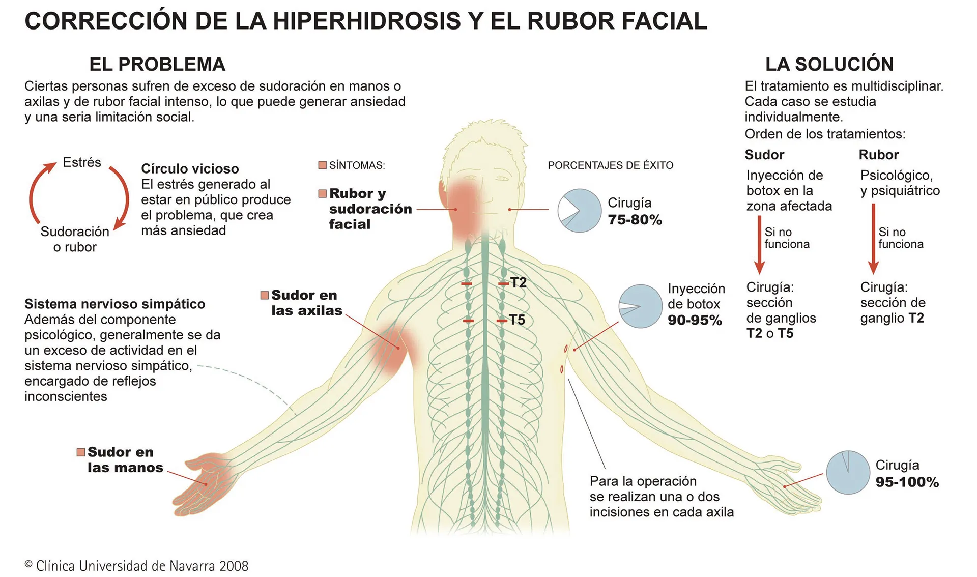 Infografía sobre un tratamiento para la hiperhidrosis y rubor facial