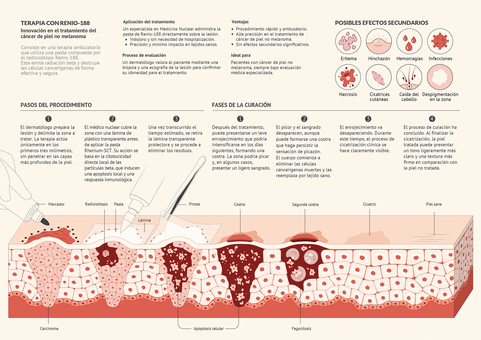 Infografía sobre el tratamiento de Rhenium-SCT para el cáncer de piel no melanoma