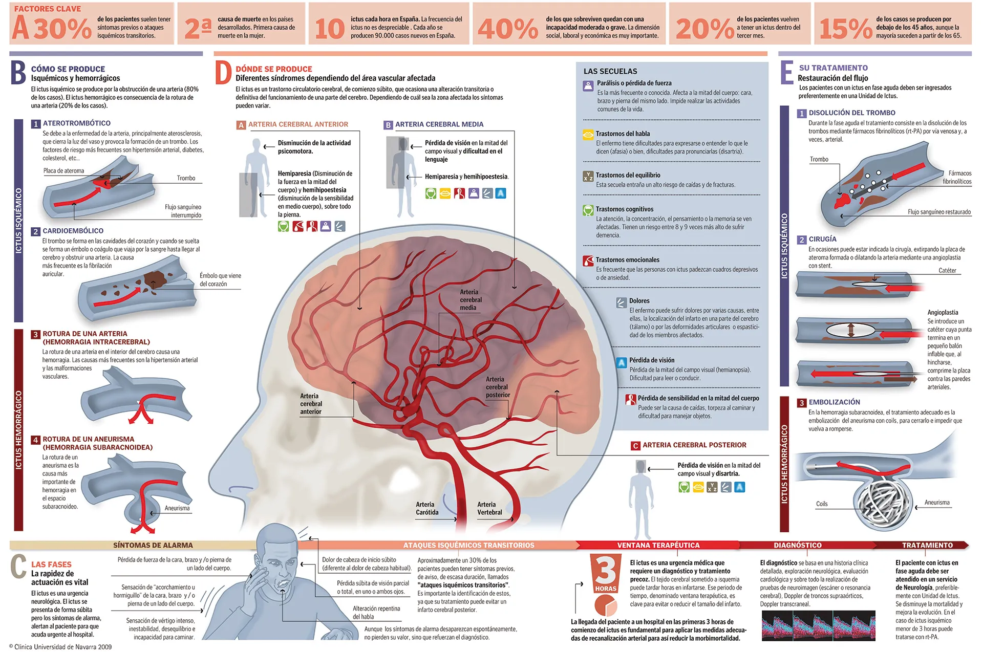 Infografía completa sobre el ictus o accidentes cerebrovascular
