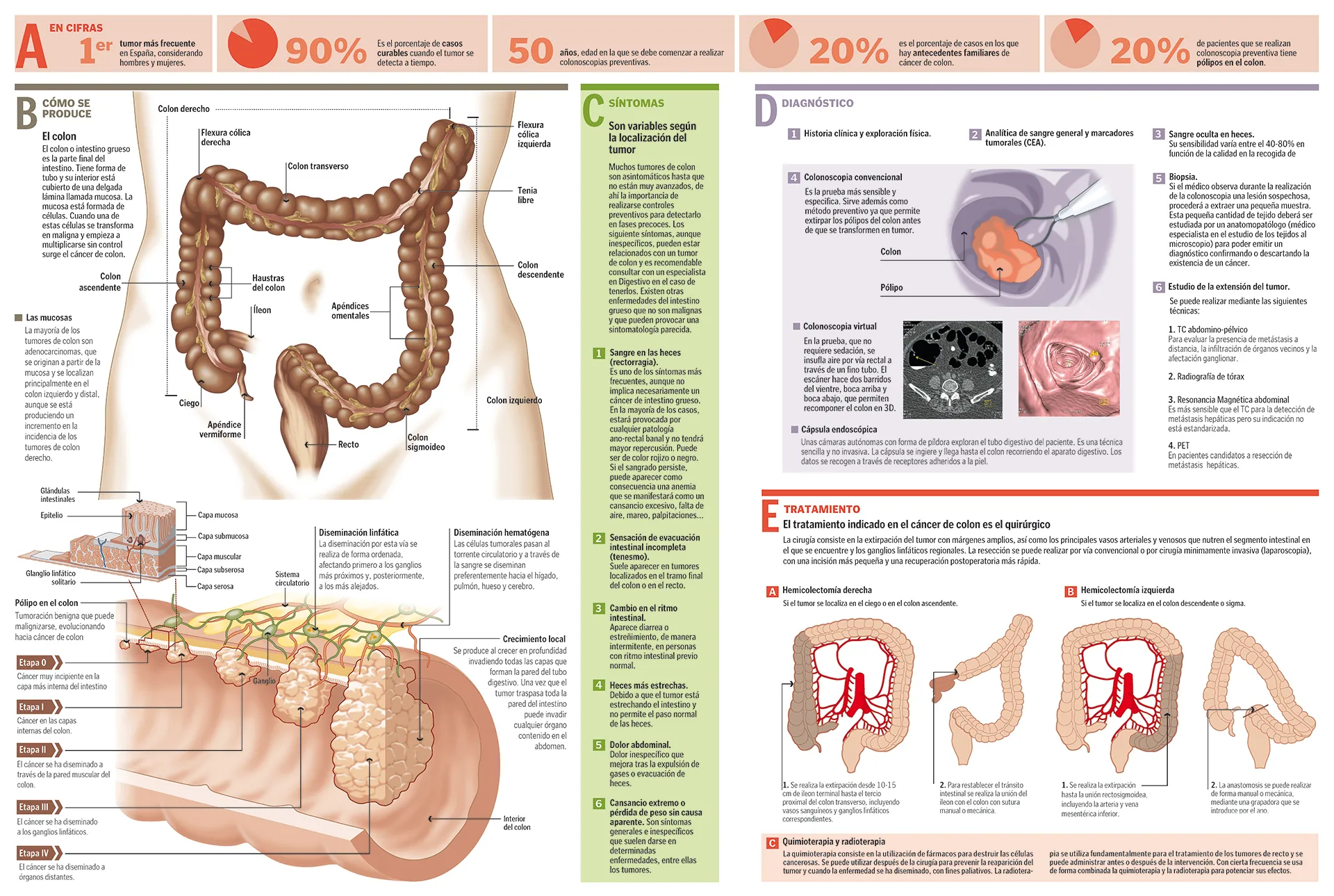 Infografías con información completa sobre el cáncer de colon