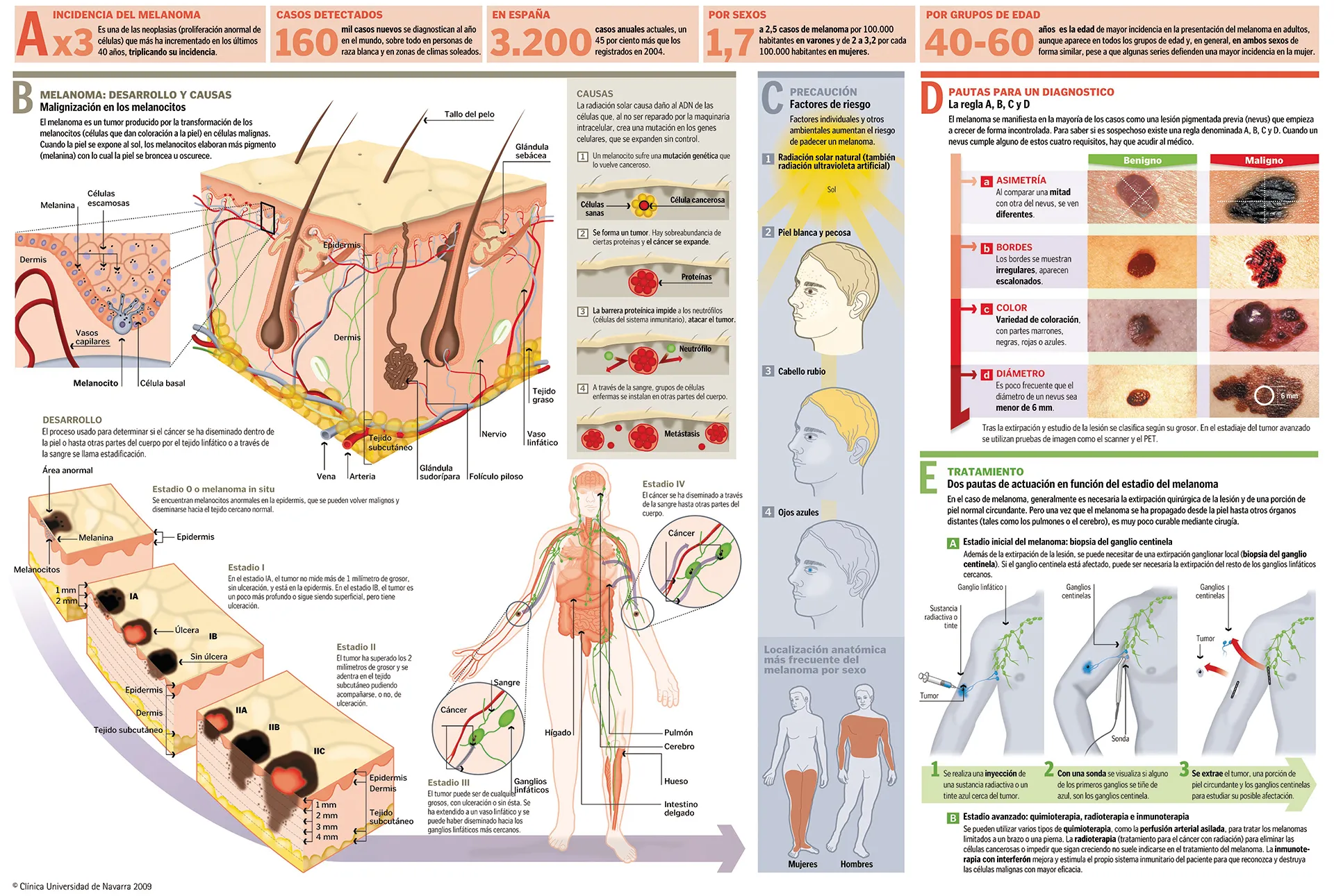 Infografía con la información completa sobre el melanoma
