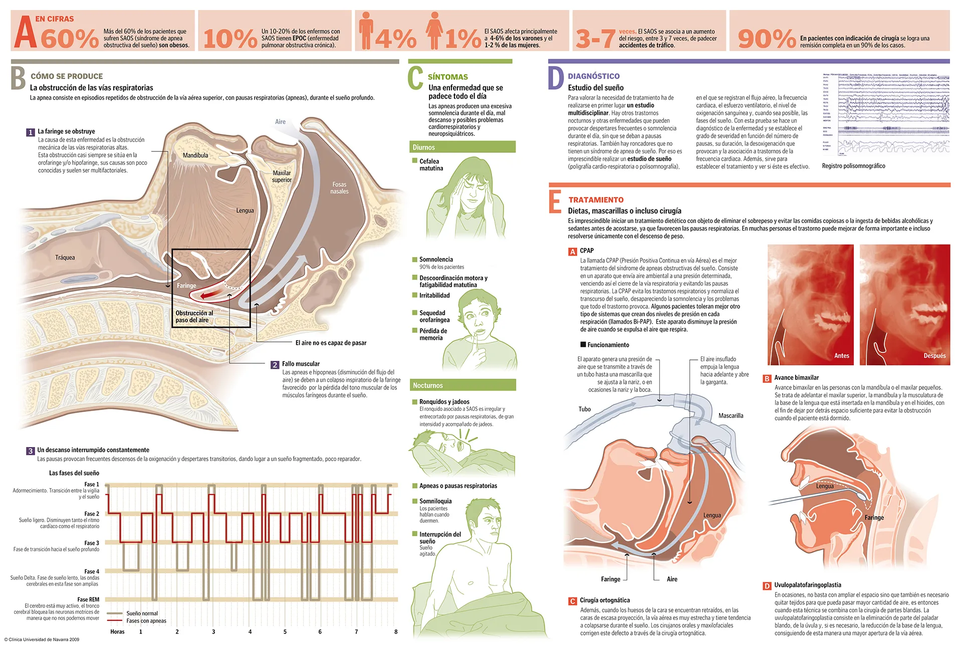 Infografía completa sobre el síndrome de apnea obstructiva del sueño