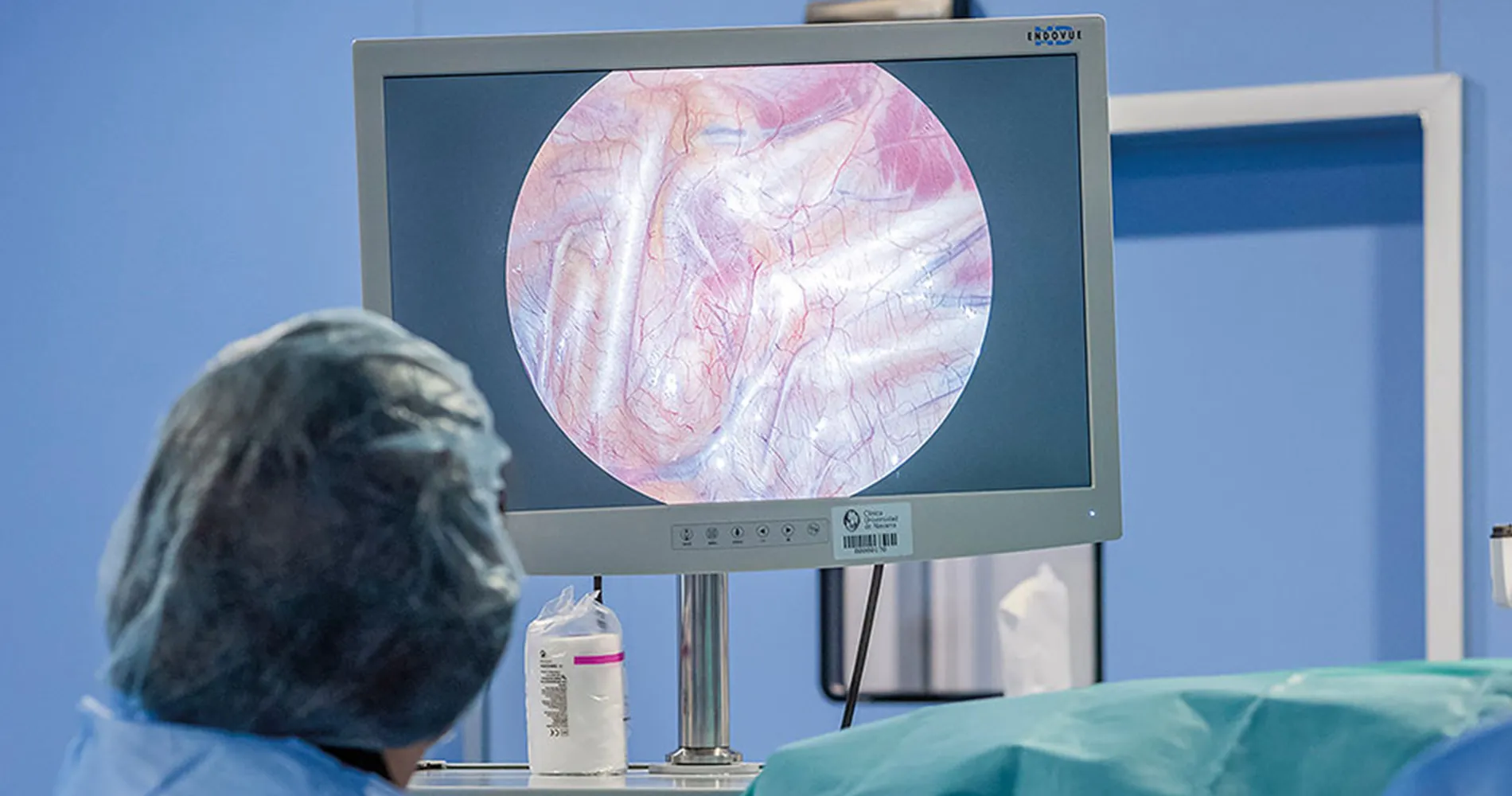 Cirugía hiperhidrosis. Clínica Universidad de Navarra Imagen de una cirugía de la hiperhidrosis realizada por la Dra. Rodríguez, cirujana torácica. Clínica Universidad de Navarra