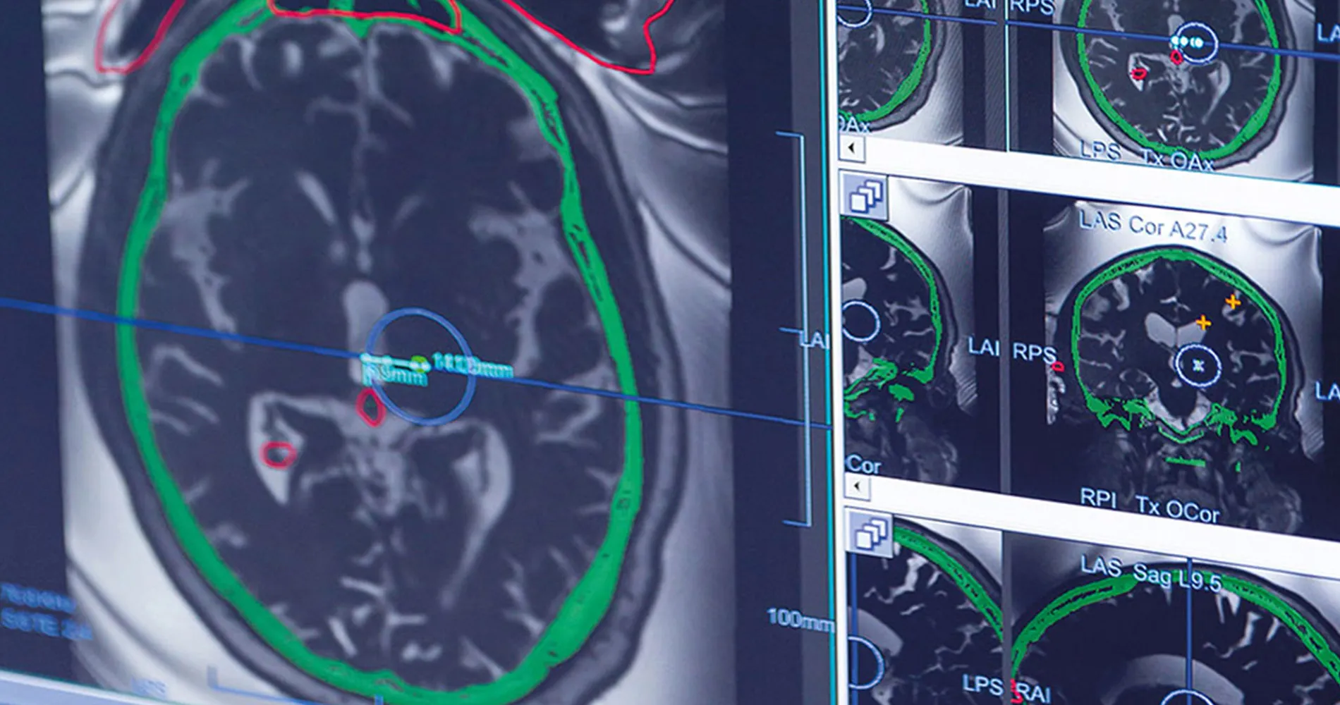Resonancia magnética tras el HIFU. Neurología. Clínica Universidad de Navarra Imagen de la resonancia magnética intraoperatoria durante el procedimiento del HIFU con los especialistas de Neurocirugía Neurología de la Clínica.