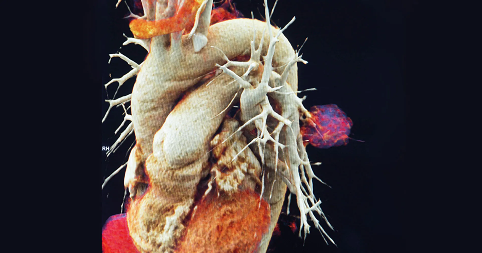 Imagen 3D reconstrucción cáncer de pulmón. CUN Imagen en 3D del hilio pulmonar con la reconstrucción de un cáncer de pulmón. Clínica Universidad de Navarra.
