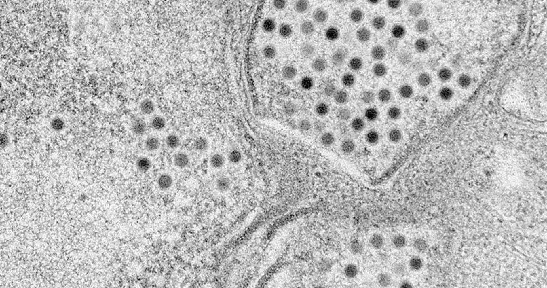 Microscopía del virus delta oncolítico. Clínica Universidad de Navarra Imagen de microscopio electrónico del virus delta-24-RGD oncolóitico en la Clínica Universidad de Navarra