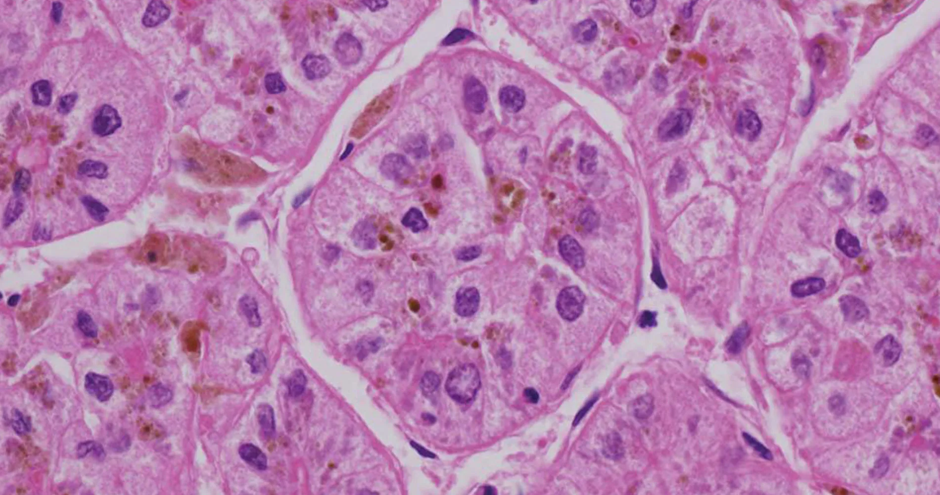 Microscopía de cáncer de hígado. Clínica Universidad de Navarra Imagen microscópica de células tumorales del hígado. Clínica Universidad de Navarra