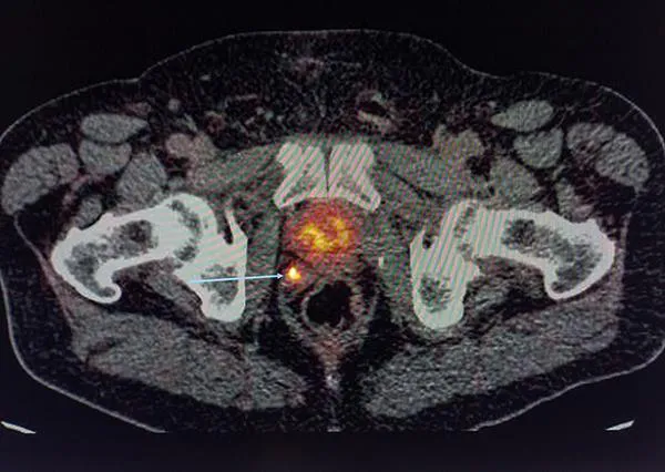 PET con galio PSMA para el cáncer de próstata. Clínica Universidad de Navarra Imagen del PET con galio PSMA para la detección del cáncer de próstata en la Clínica Universidad de Navarra