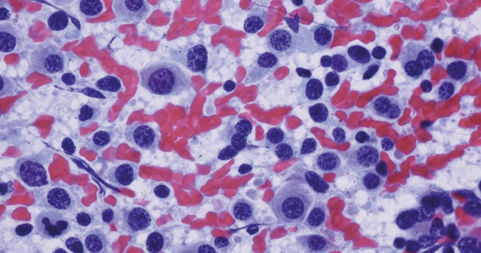 Imagen al microscopio de células de mieloma múltiple. Clínica Universidad de Navarra