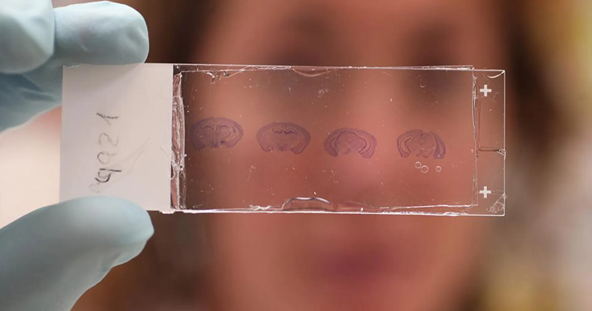 Estudio tejido cerebral. Clínica Universidad de Navarra Imagen de un investigador con una muestra de tejido cerebral. Cima y Clínica Universidad de Navarra