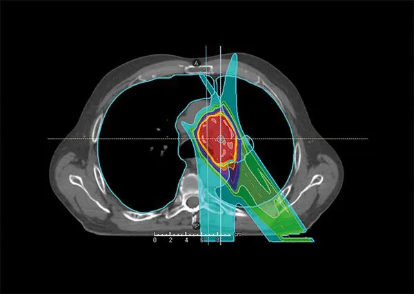 Planificación de radioterapia. CUN Imagen de una planificación del tratamiento con radioterapia en la Clínica Universidad de Navarra