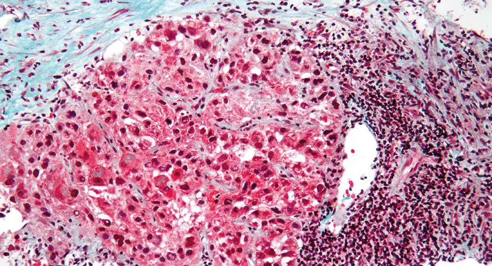 Imagen microscópica de un carcinoma hepatocelular. 