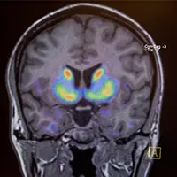 Imagen de un cerebro con párkinson Imagen del cerebro de un paciente con párkinson